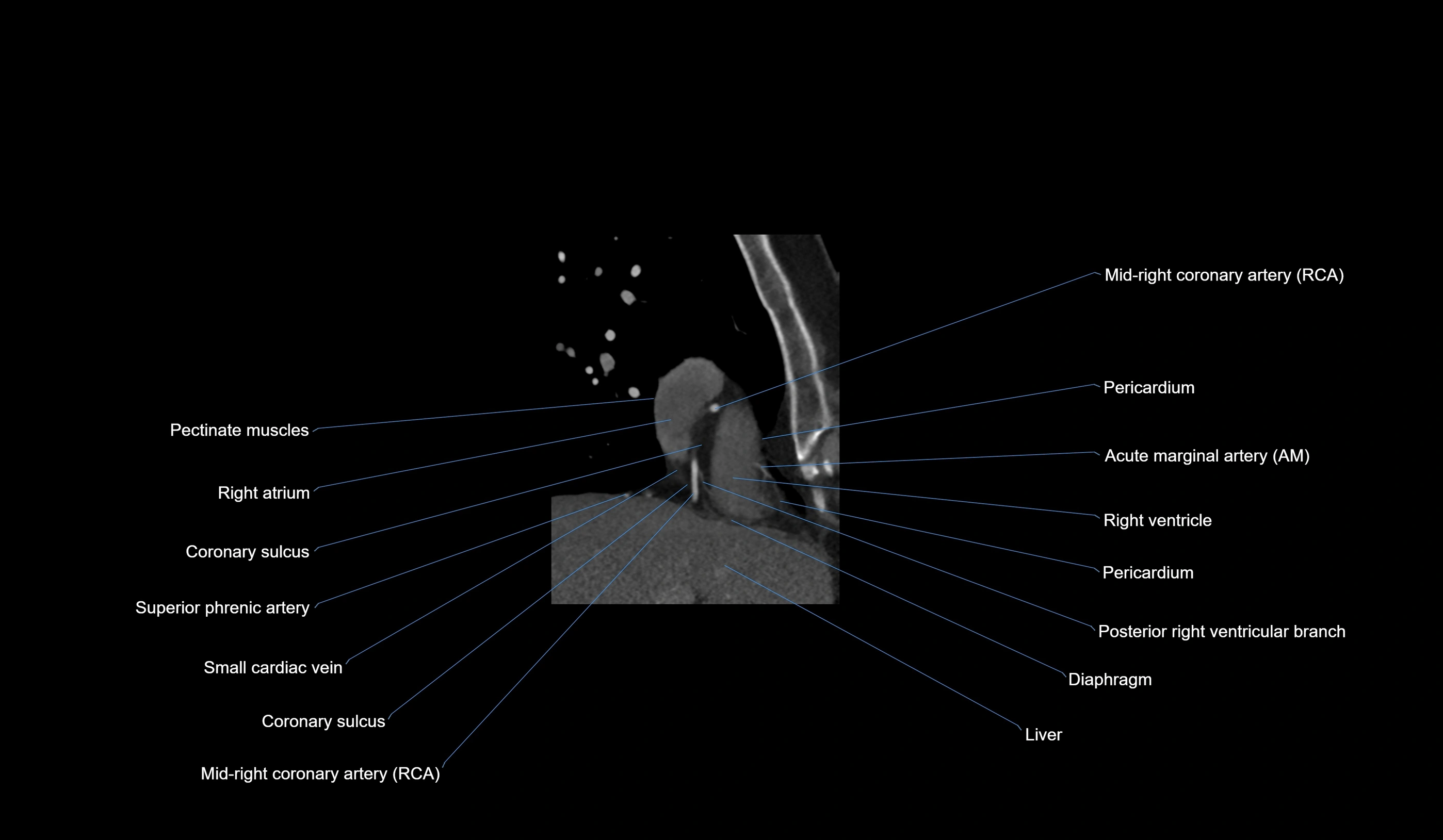 CT heart (coronary angiogram) 2 chamber view cross sectional anatomy labelled radiology image-00038.webp